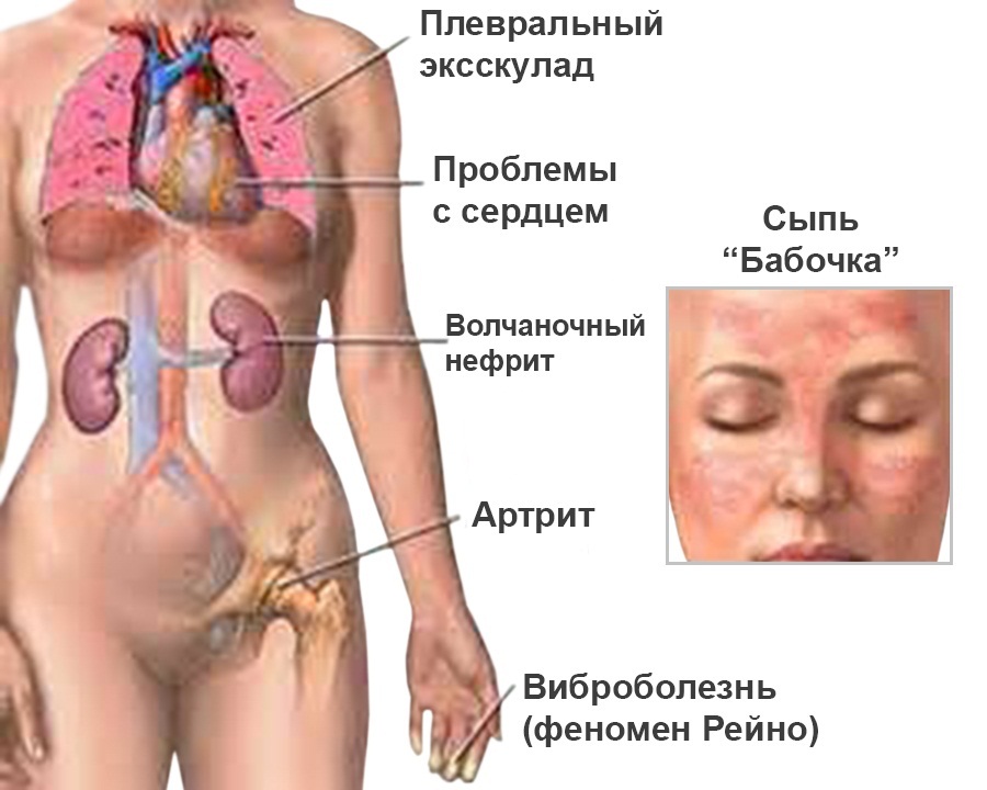 Симптомы системной красной волчанки