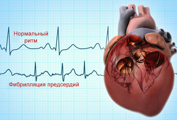 ФП является исходом многих заболеваний сердца