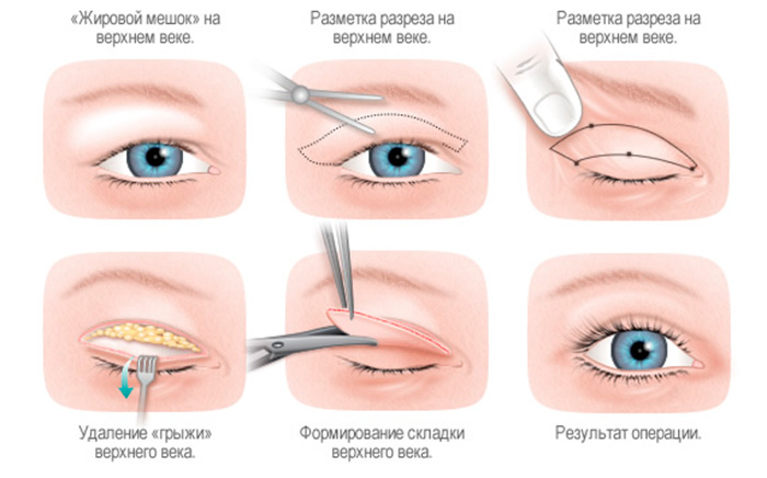 Операция блефаропластика