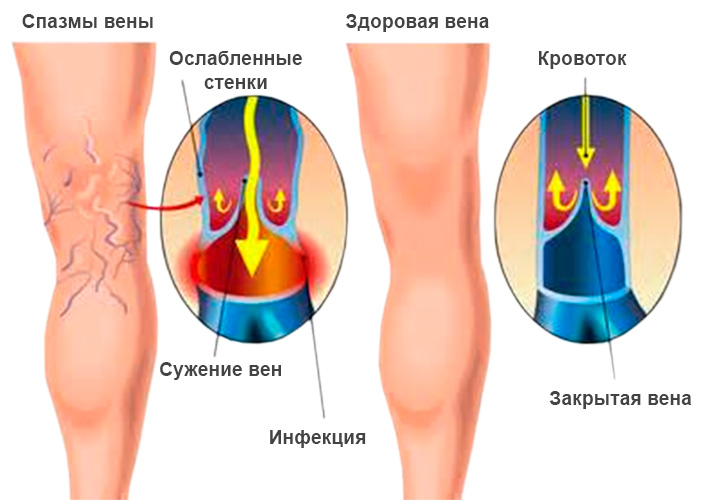 Варикоз